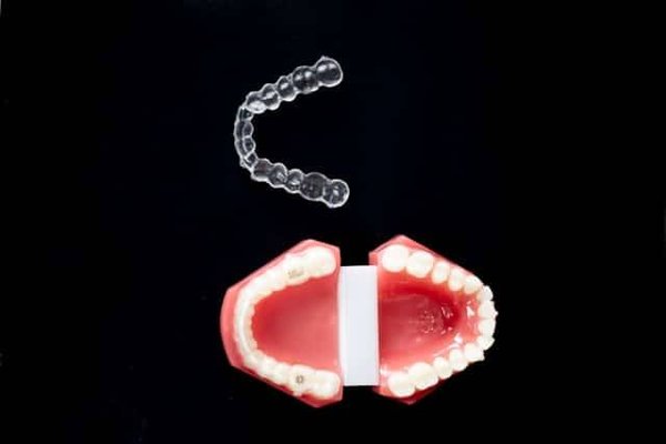Options d'alignement des dents : Trouvez la méthode adaptée à votre sourire