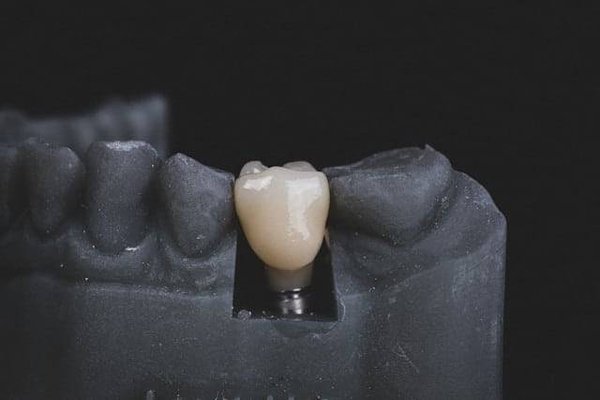 L'implantologie dentaire avance : découvrez les dernières innovations qui révolutionnent les sourires