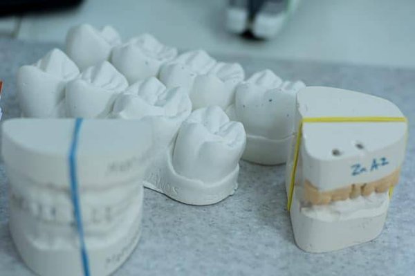 Les risques des implants dentaires : ce que vous devez savoir avant de vous lancer